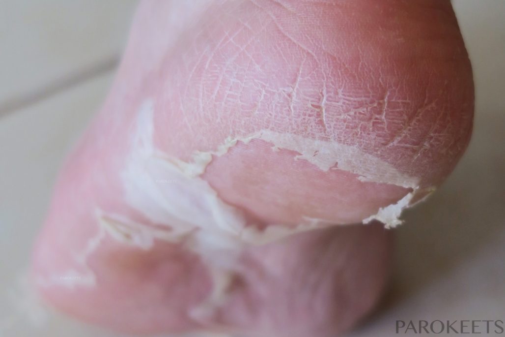 Baby Foot lupljenje kože